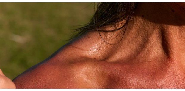 Scottature solari: conseguenze nel breve e nel lungo termine