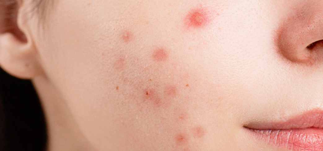 Cinque consigli per chi soffre di acne