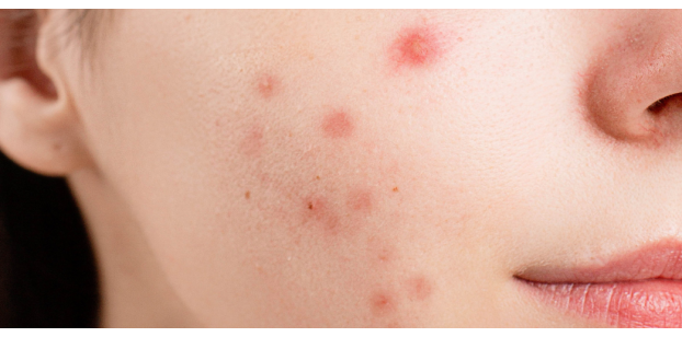 Cinque consigli per chi soffre di acne