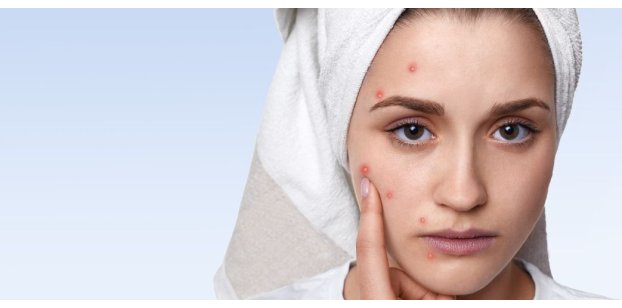 Acne in età adulta: cause e soluzioni